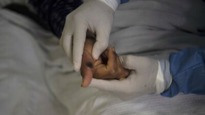 Casos de mpox en México